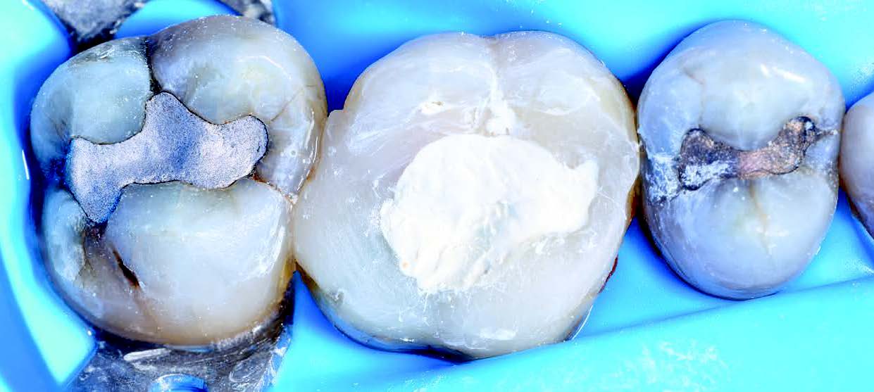 Case Studies Collection 28 – Quatre études de cas exclusives sur les cavités profondes et les dents fissurées Case Studies Collection 28 – Quatre études de cas exclusives sur les cavités profondes et les dents fissurées