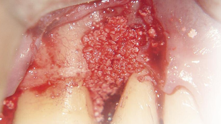 Alloplastic grafts - beta-tricalcium phosphate