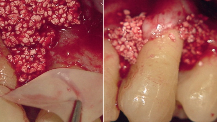  Periodontal intraoseous defects and post-extraction compromised socket. Treatment with beta tricalcium phosphate 1