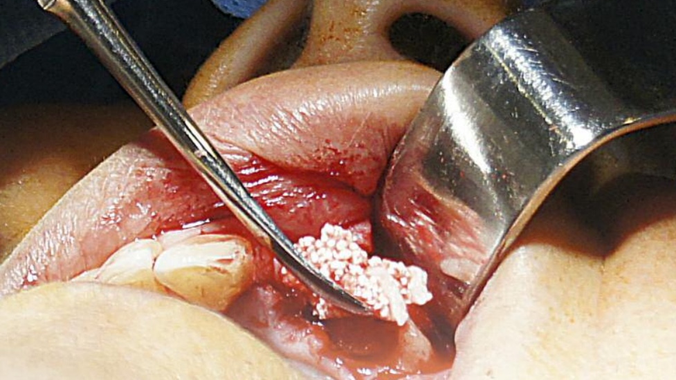 Use of R.T.R. And prf as filling material in post extraction sockets