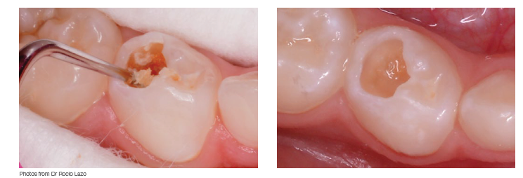 ART: Minimiser la génération de gouttelettes et d'aérosols avec la technique ART et Biodentine ™ 6