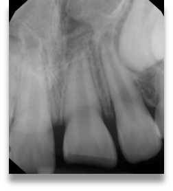 Pourquoi est-il si important pour les dentistes de préserver la pulpe des dents immatures ? 2