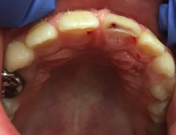 Pourquoi est-il si important pour les dentistes de préserver la pulpe des dents immatures ? 1