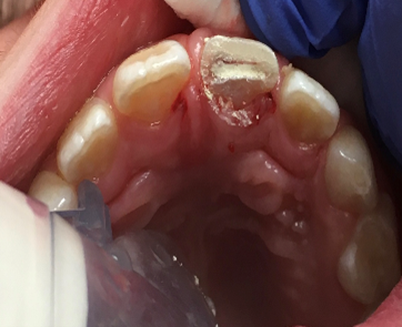 Pourquoi est-il si important pour les dentistes de préserver la pulpe des dents immatures ? 3