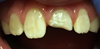 Pourquoi est-il si important pour les dentistes de préserver la pulpe des dents immatures ? 4
