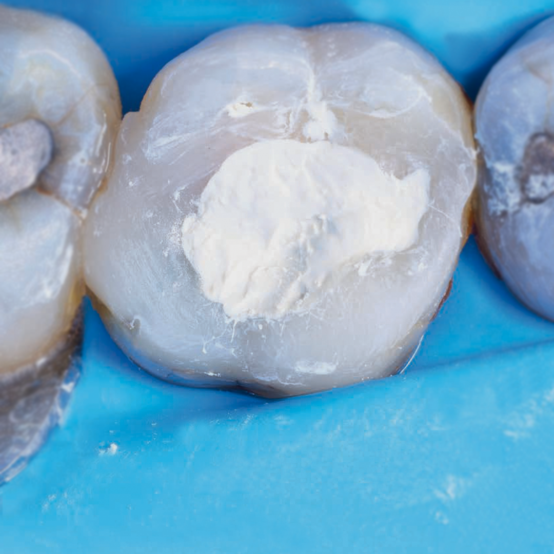 Case Studies Collection 28 – Quatre études de cas exclusives sur les cavités profondes et les dents fissurées Case Studies Collection 28 – Quatre études de cas exclusives sur les cavités profondes et les dents fissurées