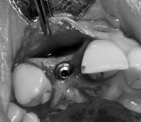 Phosphate tricalcique ß pour augmentation crête avec pose simultanée d'implants dans zone esthétique