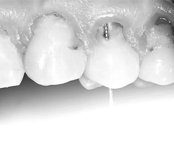 Dent avec matériau biocéramique pour lobturation du canal radiculaire