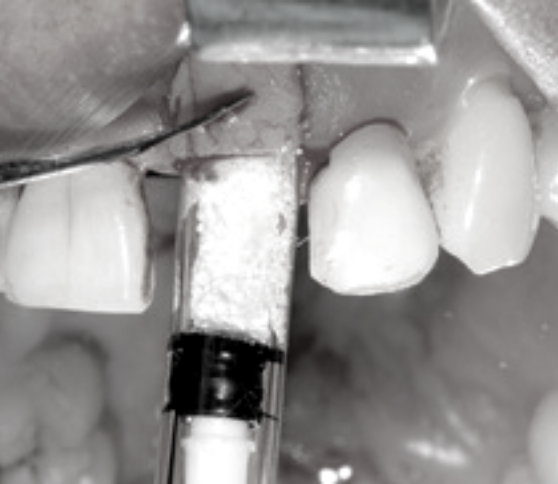 cas clinique gestion alvéole d'extraction avec R.T.R.+ et greffe de tissu conjonctif